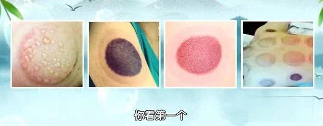 真空拔罐效果一样吗（再次爆红奥运会）(4)