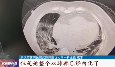 ​警惕！没烧没咳却成了“白肺”！