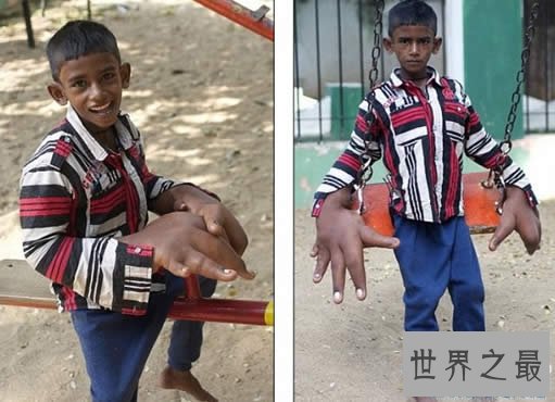 世界罕见巨指症男孩,被称恶魔之子(图)