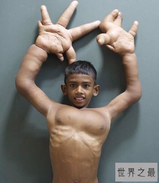 世界罕见巨指症男孩,被称恶魔之子(图)