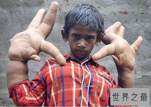 世界罕见巨指症男孩,被称恶魔之子(图)