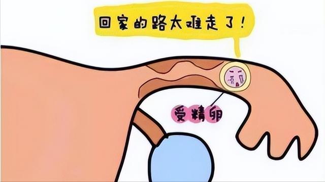 宫外孕一般是什么导致宫外孕的（宫外孕是怎么一回事）(7)