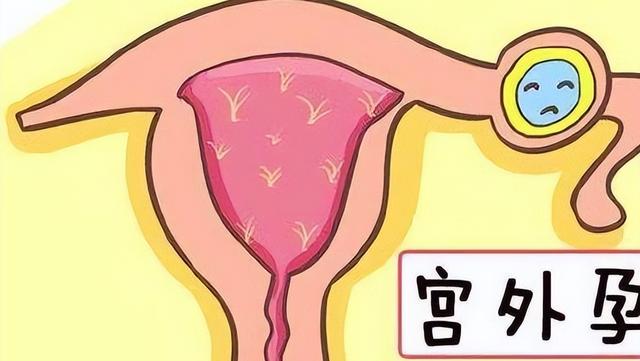 宫外孕一般是什么导致宫外孕的（宫外孕是怎么一回事）(3)