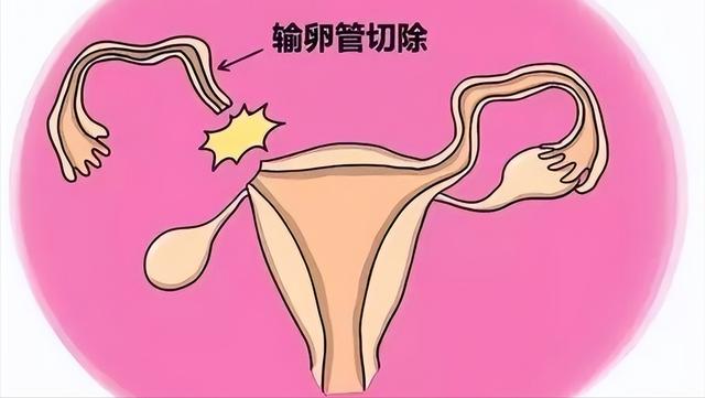 宫外孕一般是什么导致宫外孕的（宫外孕是怎么一回事）(2)