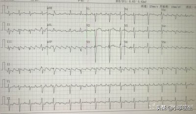 ​心电图8合集丨8份心电图让您轻松搞定房颤、房扑、房速