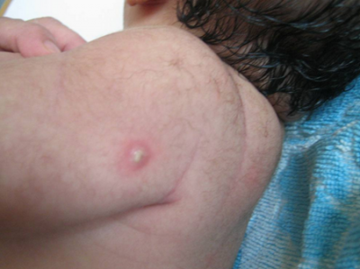 ​卡介苗 化脓 卡介苗化脓正常吗 一般两周左右出现红肿化脓