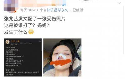 ​演员张兆艺晒受伤照片，自曝惨遭妈妈家暴，鼻子受伤裹纱眼眶含泪